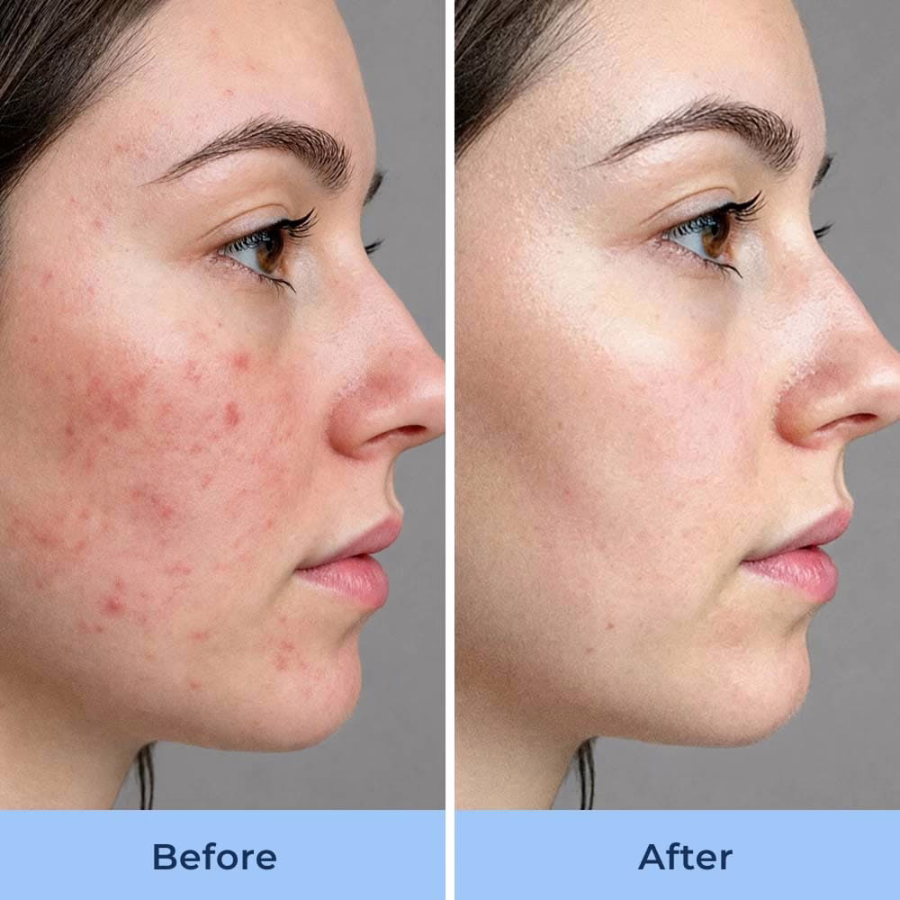 Skin before and after switching to filtered shower water